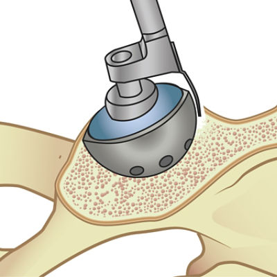 EZout Powered Acetabular Revision System Stryker